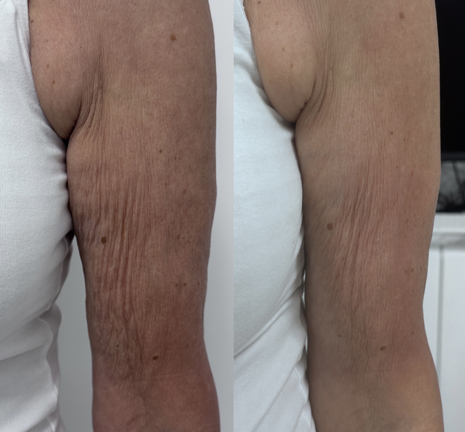 Body SkinTyte before and after