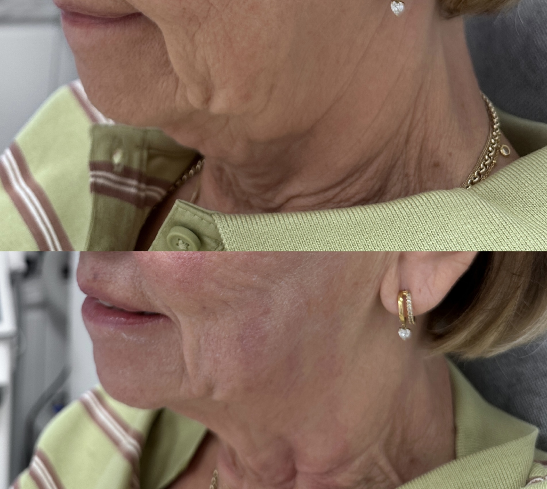 Face and Neck SkinTyte before and after