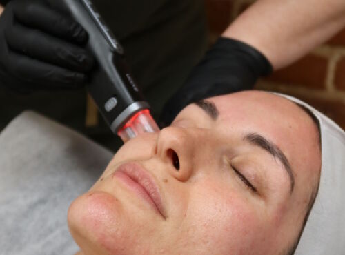 Medical Grade Microneedling